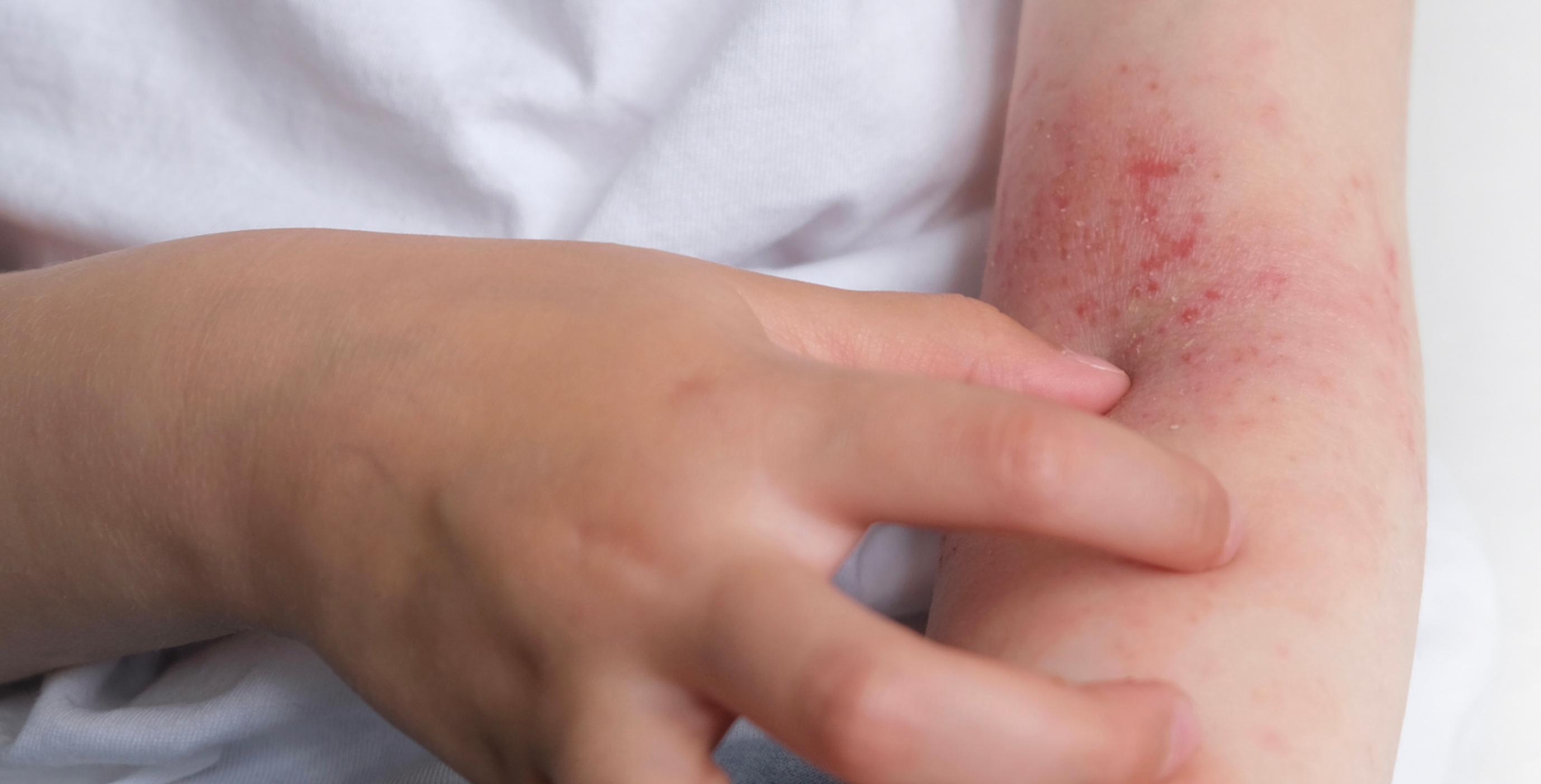 eczema che prude